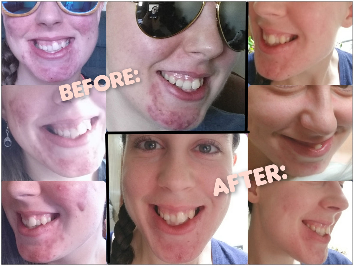 Clear Skin Acne Blasting Face & Body Spot Treatment